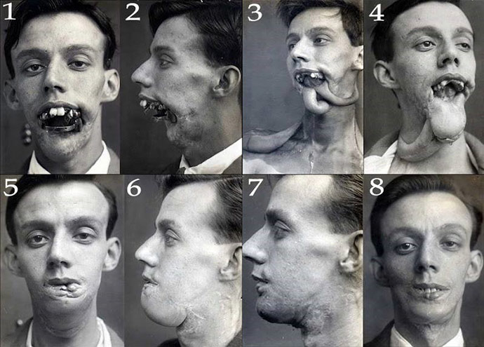 How World War One Invented Modern Plastic Surgery
